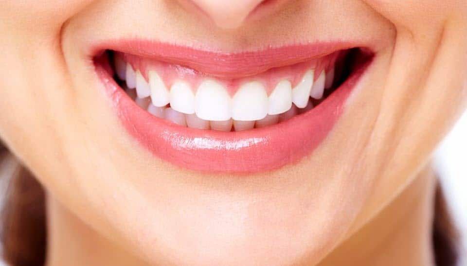 Implantes dentales - Sonrisa